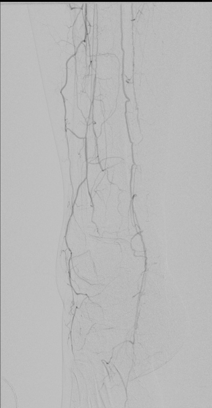 Tibial Peroneal Patch Angioplasty
