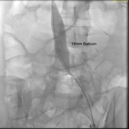 large-balloon-in-iliocaval-vein